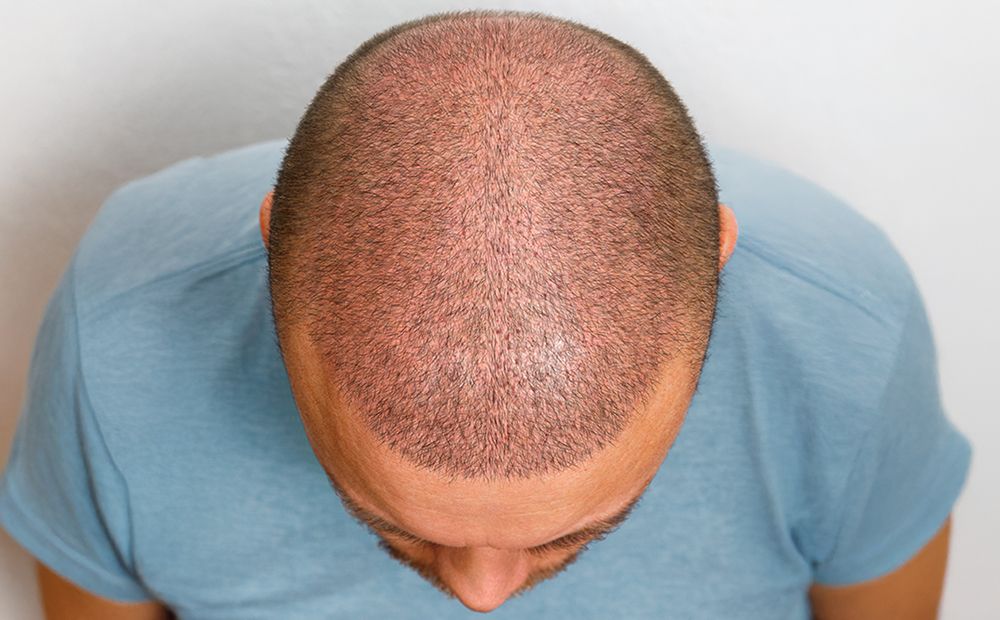 Hair Transplant